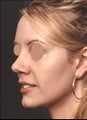 Revision rhinoplasty