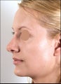Revision rhinoplasty