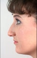 Rhinoplasty to make the face appear younger