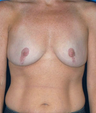 Breast Implant Revision