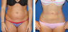 Liposuction Before & After
