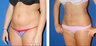Liposuction Before & After