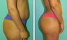 Brazilian Butt Lift Before & After