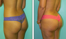 Brazilian Butt Lift Before & After