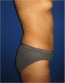 Laser Liposuction