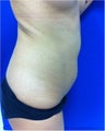 Laser Liposuction