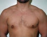 Adult Male treated for Breast Reduction