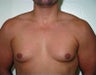 Adult Male treated for Breast Reduction