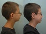 Otoplasty or Ear Surgery