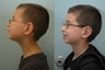 Otoplasty or Ear Surgery