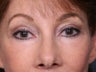 Brow Lift