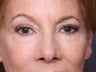 Brow Lift