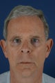 63 y.o. Male Liquid Facelift with Fillers