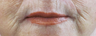 Laser resurfacing with subcision around mouth