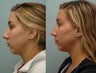 Nose Surgery / Rhinoplasty