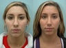 Nose Surgery / Rhinoplasty