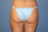 Smartlipo