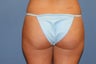 Smartlipo