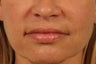 Treatment of NL Creases