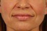 Treatment of NL Creases