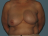 Received a left breast implant and a Breast Reconstruction after tissue expansion.
