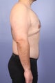 37 yr old weight loss patient