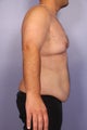 37 yr old weight loss patient