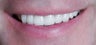 Porcelain Crowns and Veneers