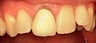 Porcelain Crowns and Veneers