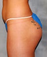 Buttock Augmentation
