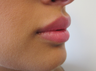 Lip Filler with Juvederm Volbella