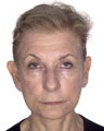 Otoplasty