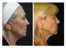 Ultherapy