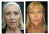 Ultherapy