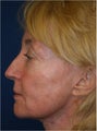 64 year old female treated with Sculptra for facial sagging due to volume loss