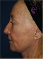 64 year old female treated with Sculptra for facial sagging due to volume loss