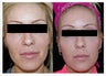 Before and After Sculptra Dermal Filler Biostimulant Injections