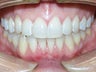 Very crowded upper and lower teeth treated with Invisalign