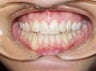 Very crowded upper and lower teeth treated with Invisalign