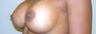 Breast Enhancement