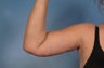 Arm Lift