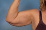 Arm Lift
