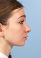 Female Chin Implant