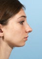 Female Chin Implant