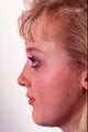 Rhinoplasty