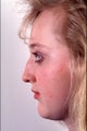 Rhinoplasty