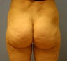 Liposuction