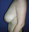 Breast Lift