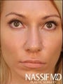 Female Primary Rhinoplasty