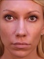 Female Primary Rhinoplasty